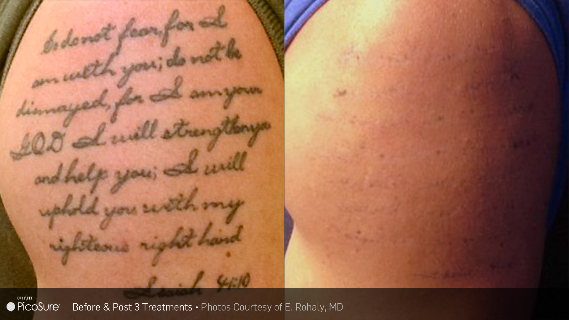 laser tattoo removal revlite laser fast effective laser tattoo removal revlite laser fast effective