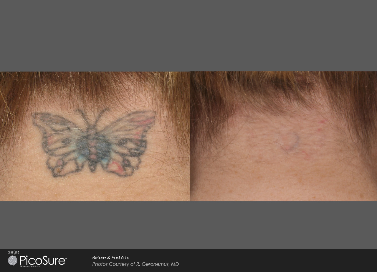 100+ [ Lasercare Advanced Tattoo Removal Center 