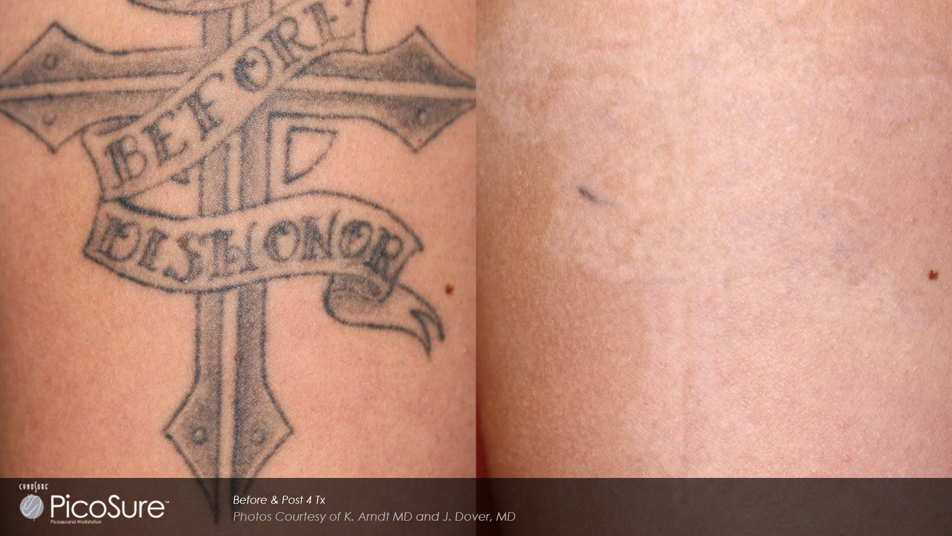ba-picosure-cynosure-post4tx-cross