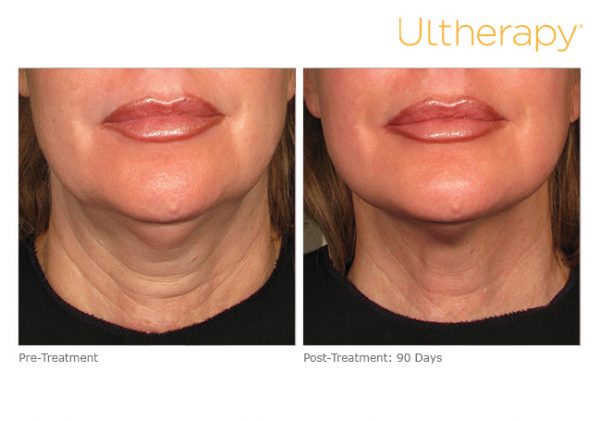 Ultherapy Skin Tightening | Dermatology and Laser Centre of Los Angeles